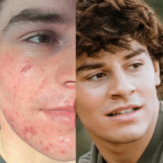 Clean Face - Como eliminar el Acné lo mas rapido posible + 10 regalos exclusivos