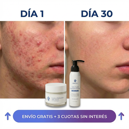 El Acne de tu hijo no es tu culpa… Pero sí podés solucionarlo en 15 días