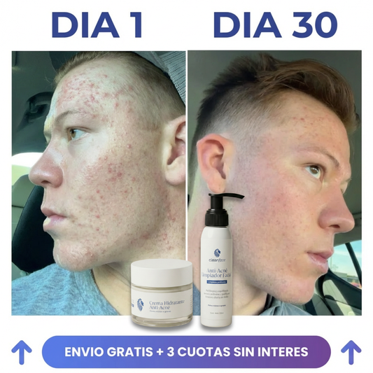 Entrás a un lugar y sentís que todos miran tu Acné. Dale solución real en 2 semanas